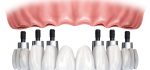 ایمپلنت یا کاشت دندان چیست ؟